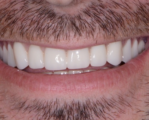 Acrylic Dentures Springdale WA 99173